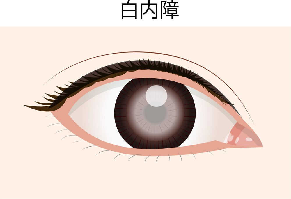 白内障